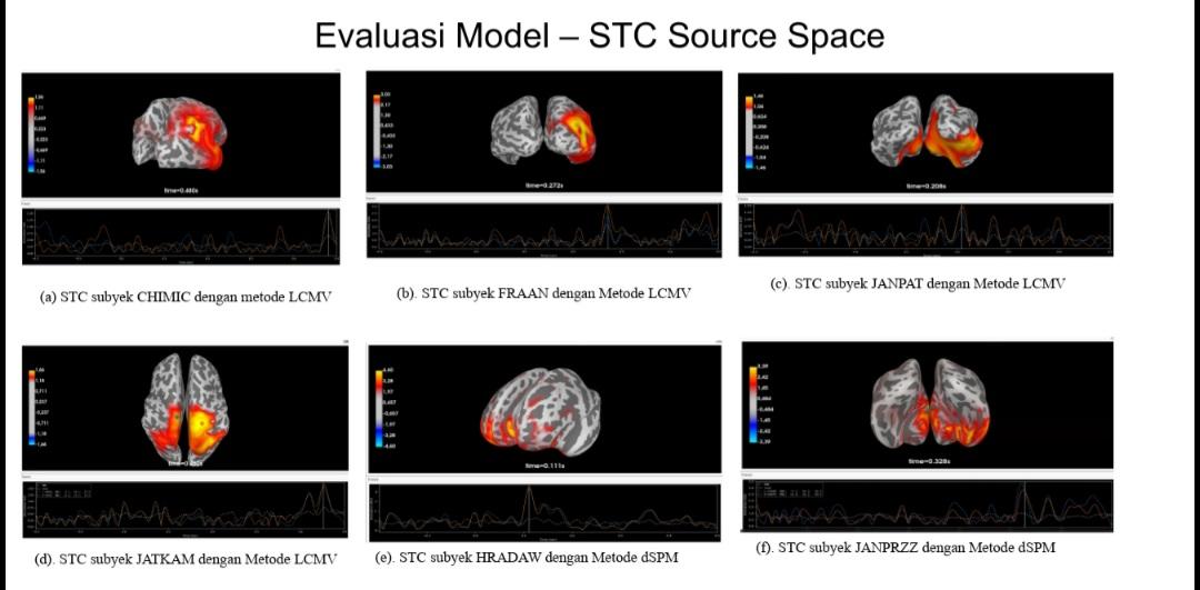 MRI. Scan otak yang ditangkap oleh MRI dan diimplementasikan pada topography map untuk melihat pergerakan energi yang dapat menunjukkan lokasi sinyal IED. (foto: its)